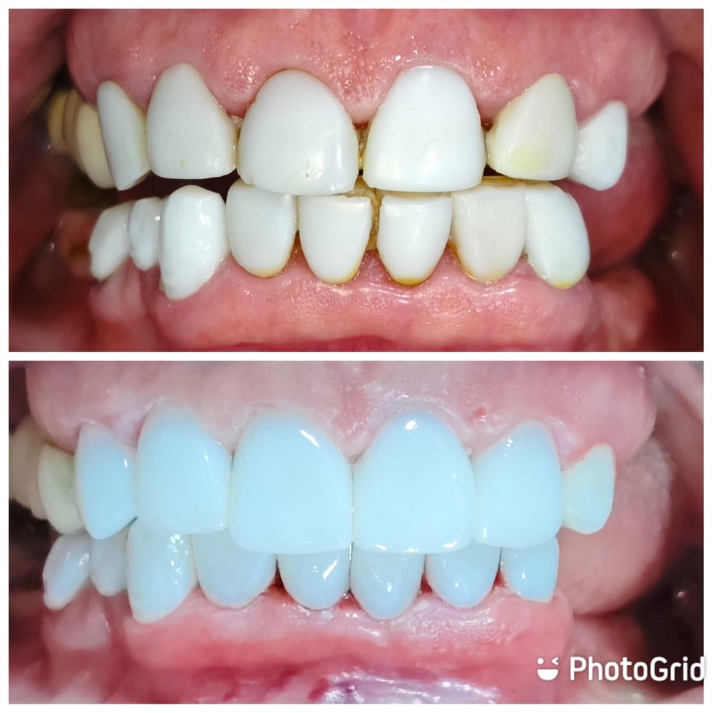قبل وبعد تركيبات تجميلية
