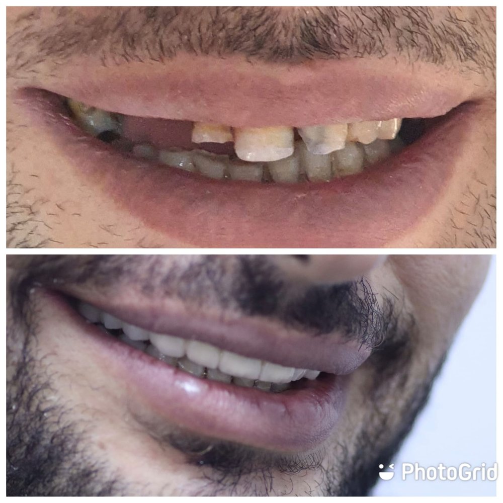 قبل وبعد ابتسامة هوليوود