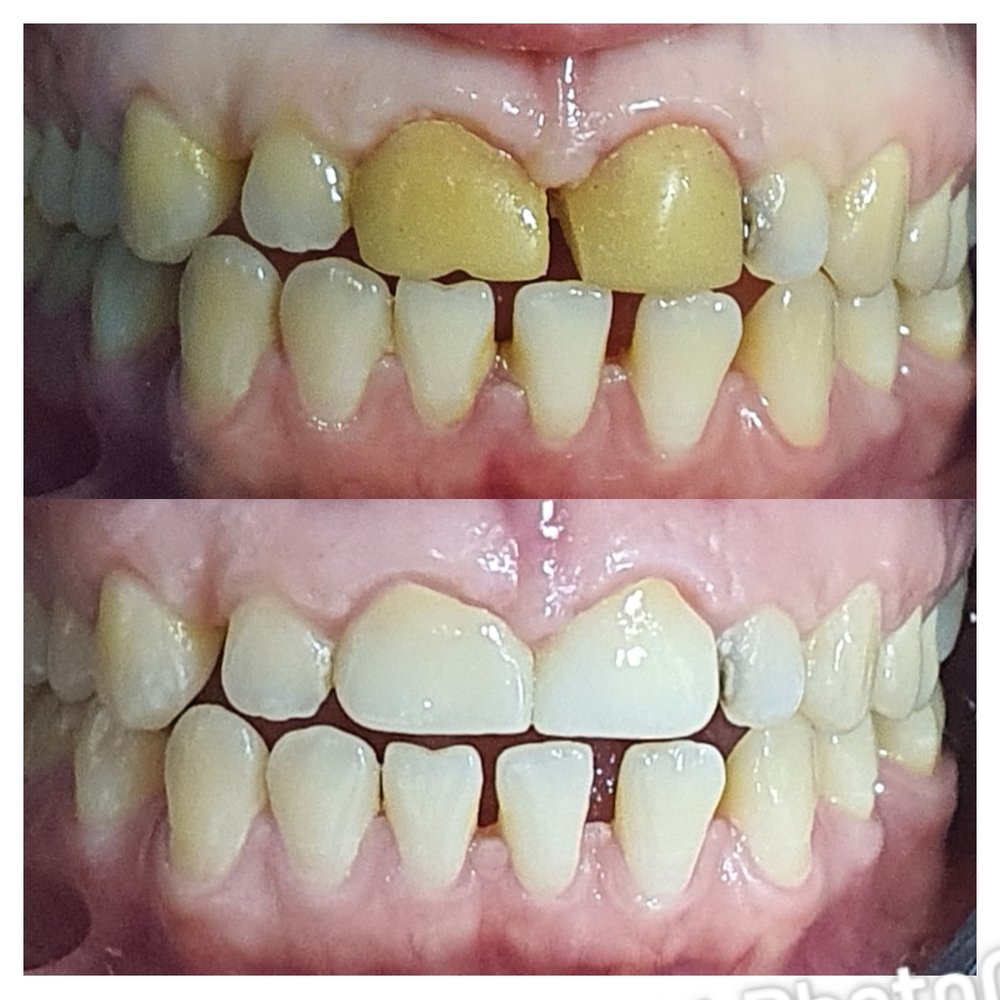 قبل وبعد حشوات تجميلية